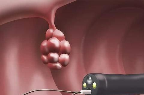 肠息肉|肠道里长了“息肉”，上厕所时早有提示，不要等到中晚期才发现