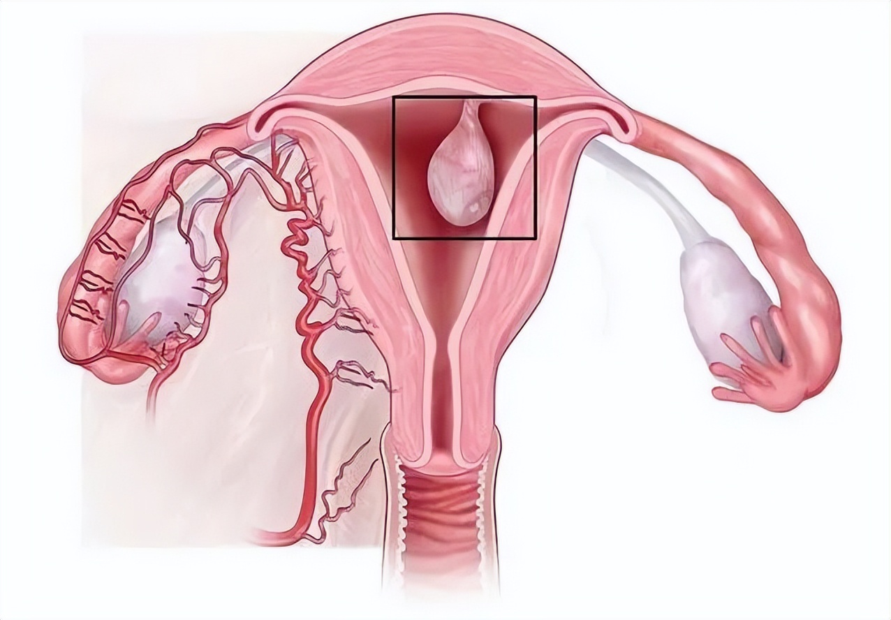 维生素B|移植发现子宫内膜息肉！试管之路还能继续吗？