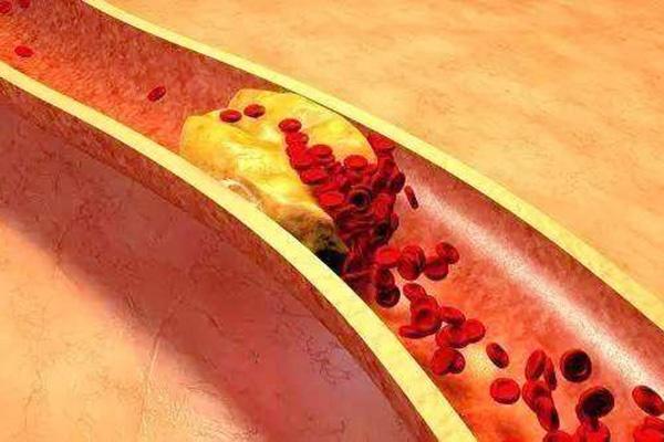 甘油|甘油三酯高过1.7,血液已粘稠!这两个时间喝水,稀血液,远粘稠