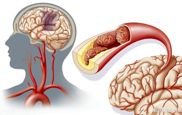 运动|运动不当会要命!糖尿病的六种并发症怎么运动?教你几招科学应对