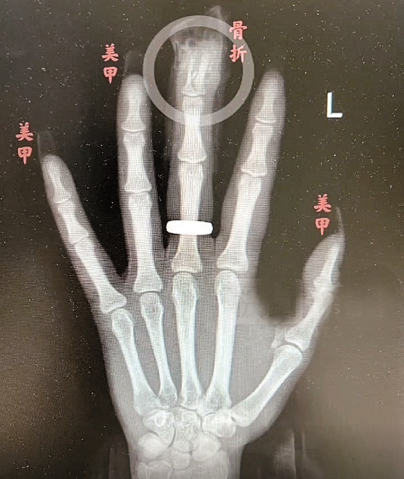医生 女子过度美甲摔倒后引发骨折,医生这样说