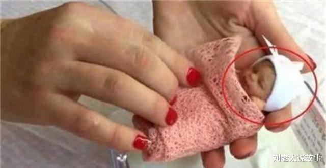 现实版“拇指姑娘”！出生时仅25厘米，打破世界纪录，如今18岁怎样了