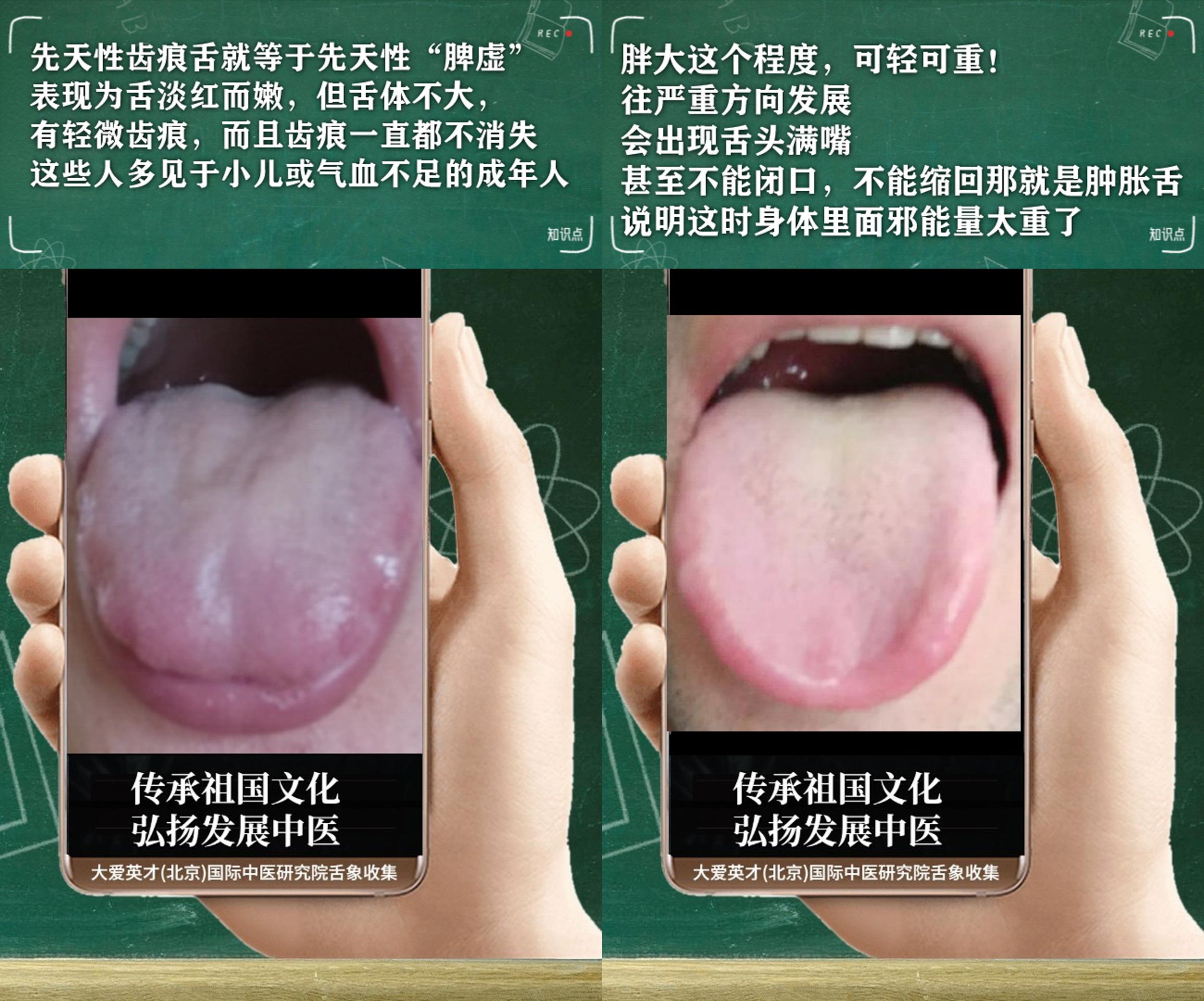 咳嗽|中医分析:易愁苦,手足心热,咳嗽重,吐黏痰,经常复发很绝望