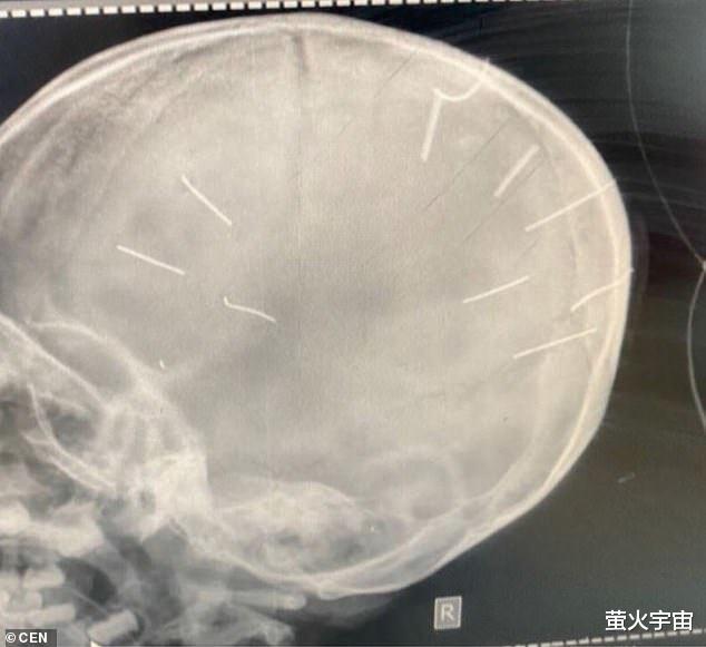 越南3岁女孩被妈妈的男友残忍杀害,头骨钉入9根钉子,惹众怒
