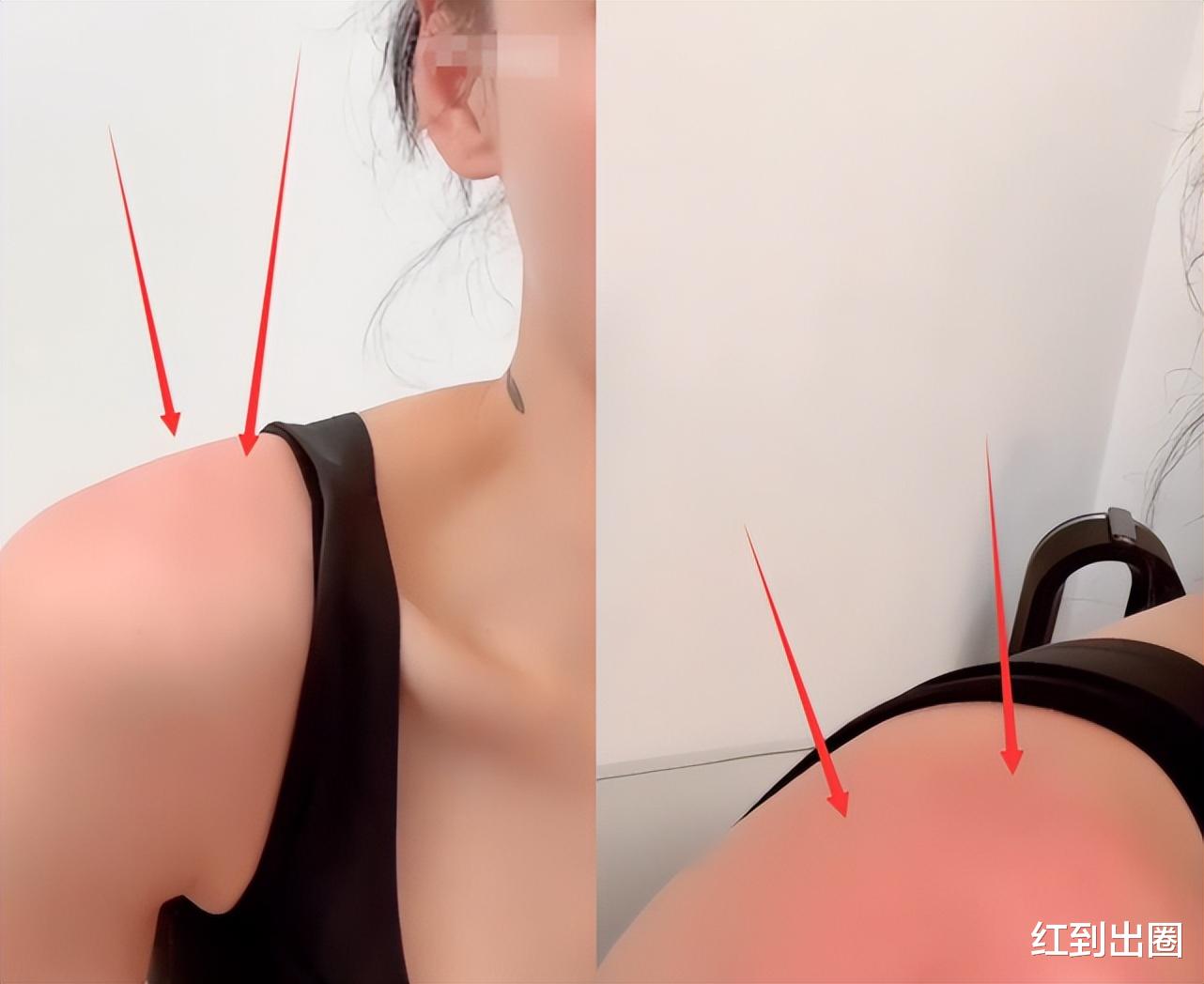 张柏芝|41岁张柏芝游泳被晒伤，仅穿一件背心露出排骨胸，肩膀处又红又肿