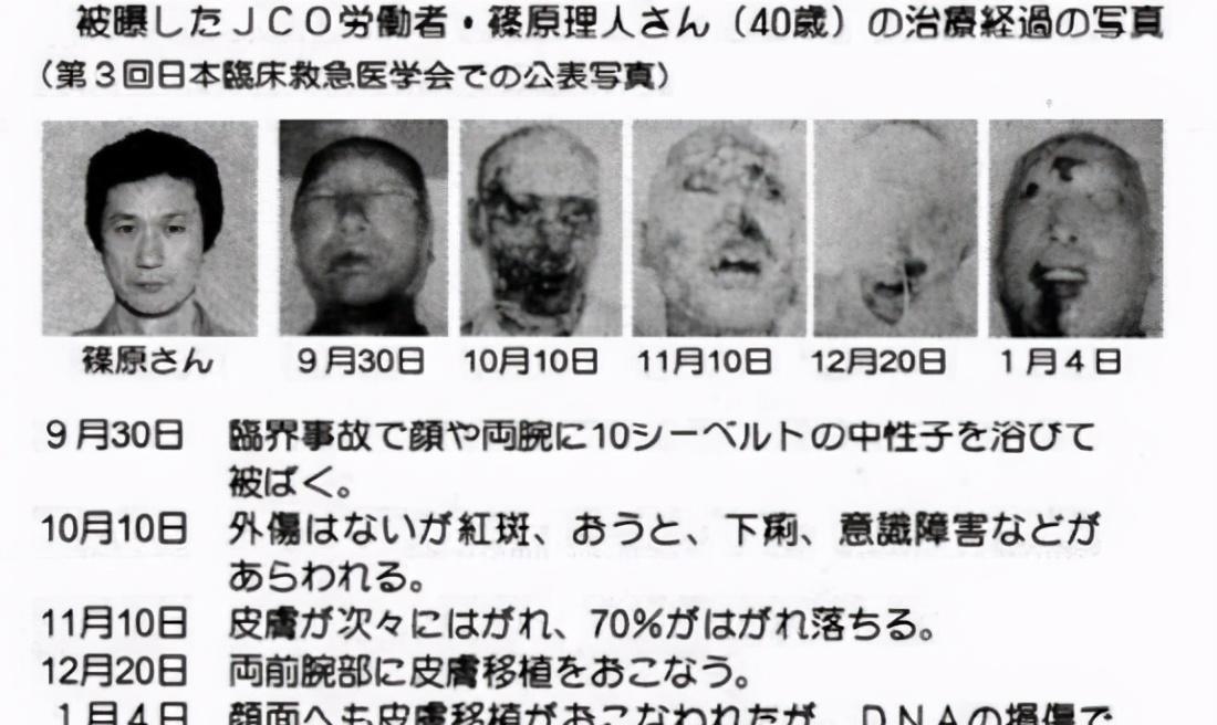 全身DNA断裂会发生什么?全球只有一个人不幸遇到,结果很心痛