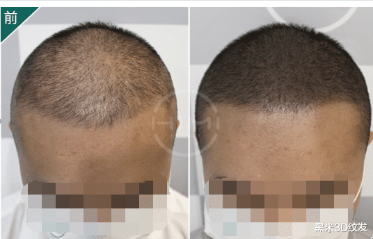 脱发|脱发秃顶,可能是这些原因引起的!