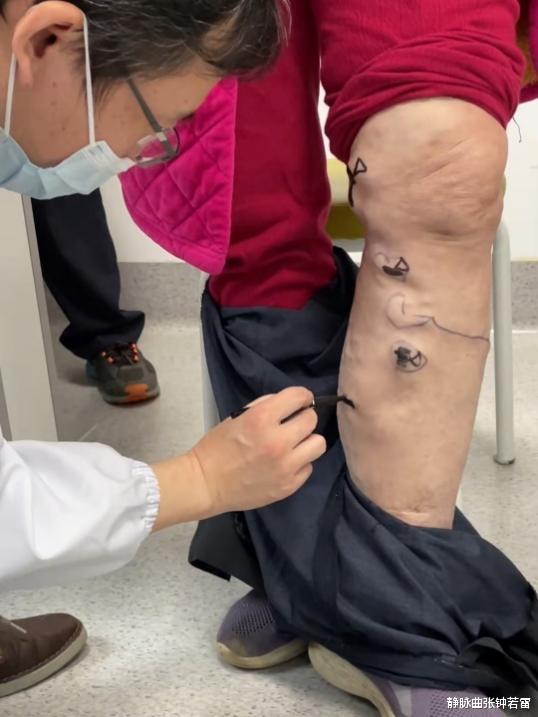 ct检查|72岁婆婆左腿胀痛，血管突起似圆球，背后竟是它在作怪？