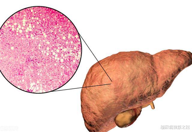 |肝脏脂肪与腹部脂肪，哪个才是糖尿病关键因素？不要搞错了