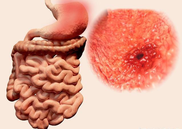 胃炎|患“糜烂性”胃炎的人，若不尽早治疗，可能会招来3个“麻烦事”