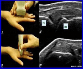 抗体|类风湿应该做哪些检查？一分钟带你了解