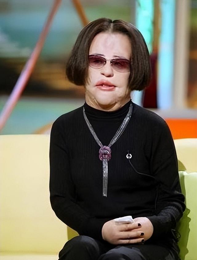 韩慧景|“整容上瘾”韩慧景：把脸整成电风扇，自行注射大豆油，代价惨痛