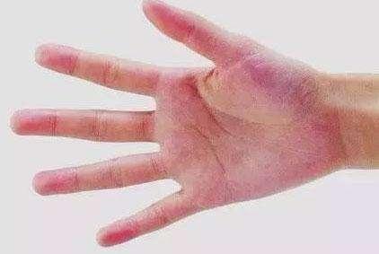 肝脏|肝好的人，手上没有这4个“信号”，若你一个也没有，那就恭喜