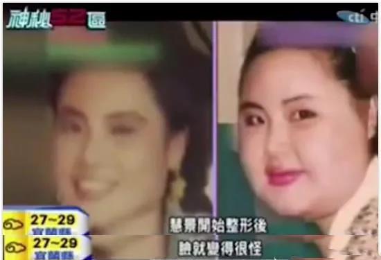 王一博|女星韩慧景:为了更漂亮,给脸注射食用油,把脸整成“猪头”