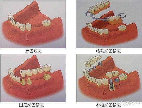 牙齿|镶牙的哪些事儿和日常的维护