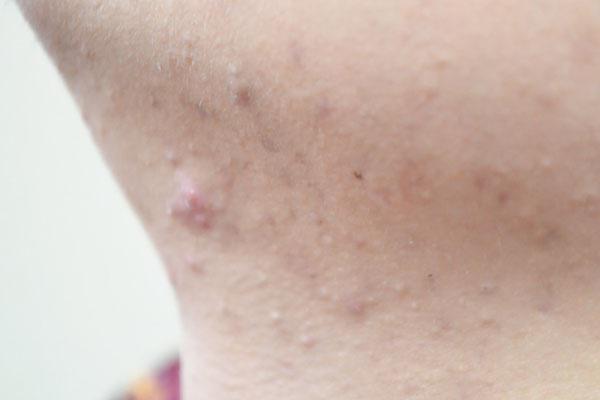 咳嗽|肺不好，身体多会有四种症状提醒你，若一条没有说明肺还挺健康的