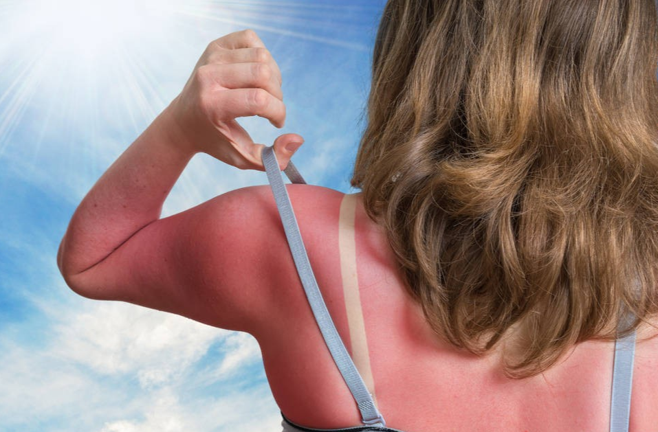 防晒 防晒霜不是可有可无的！别等到皮肤被晒黑了，才明白防晒的重要性