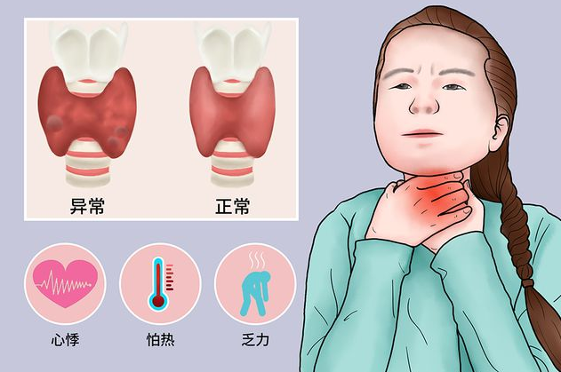 甲状腺癌|坚持早起一杯“水”,39岁女教师甲状腺癌离世,医生:喝一口堪比10斤白酒