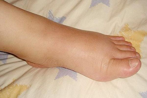 黄芪|当肝发生病变，手脚可能会有3种“麻烦”，若一个没有，肝还不错