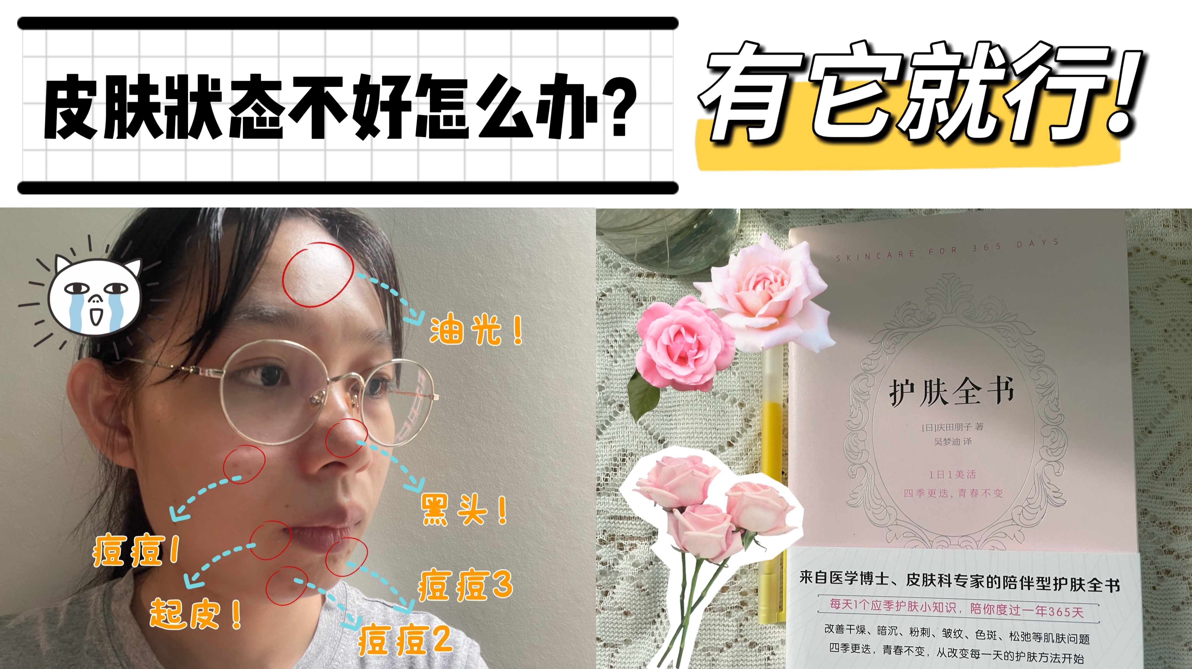 痘痘 皮肤状态不好怎么办？脸部爱出油、黑头、痘痘、起皮，有它就行！