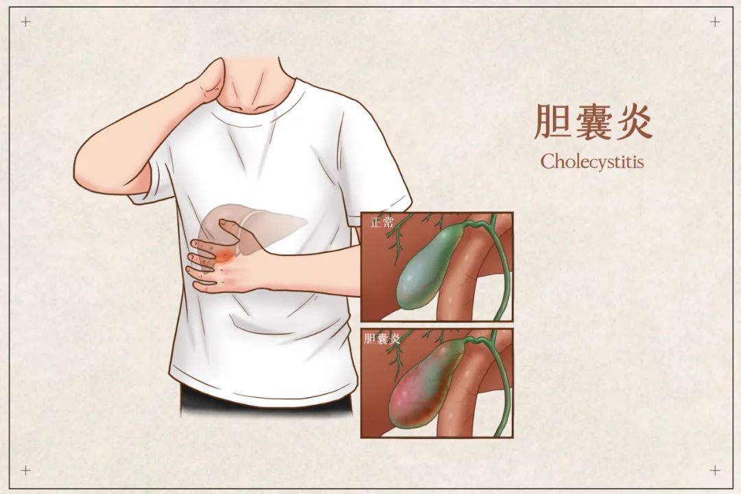 营养早餐|更年期为什么易患胆囊炎？这3件事你一定要做好