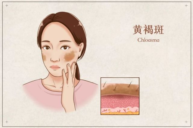 西瓜|皮防科普 | 最容易长斑的四个“黄金期”，该如何预防？