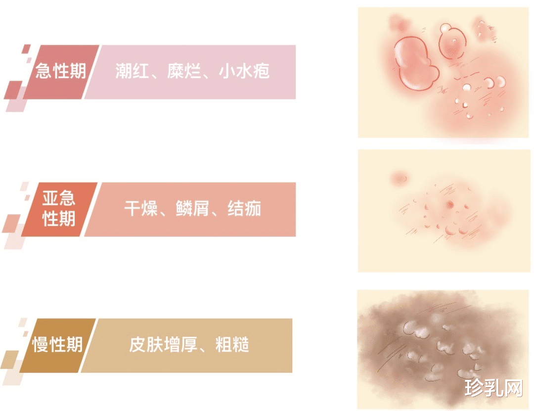 切口|有“痒”说不出!乳房湿疹到底是什么病?