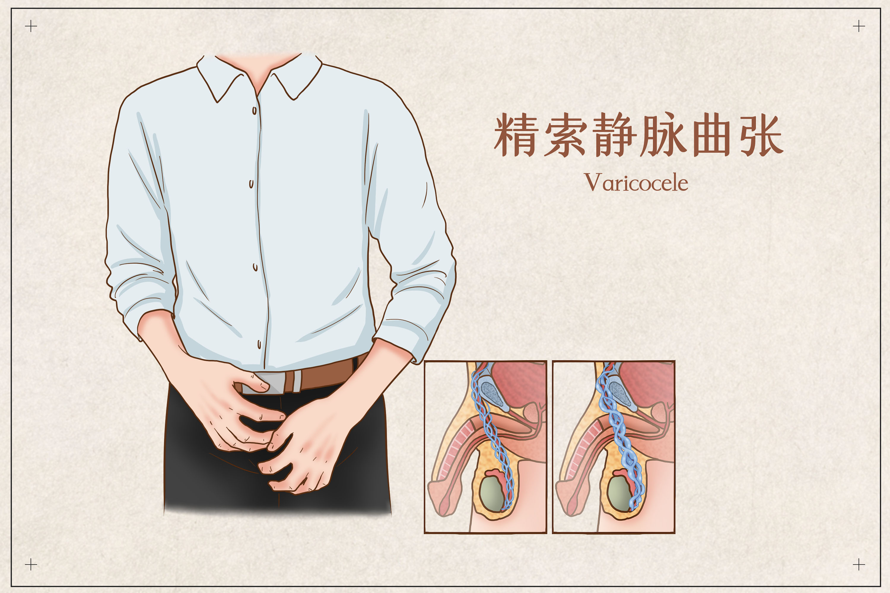 静脉曲张|川蜀专家告诉你:精索静脉曲张检查没那么可怕,很简单!