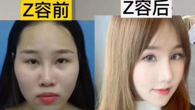 女孩整容被识破，亲戚要求退还100万彩礼：整容堪比换脸影响基因