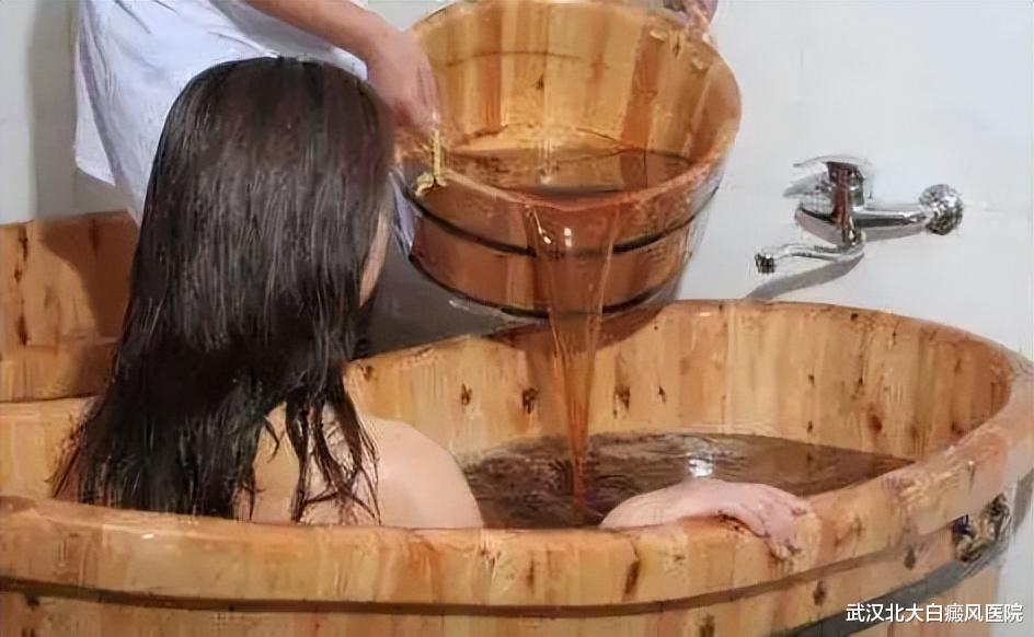 高血脂|让患者享受式治疗白癜风,中医药浴做到了