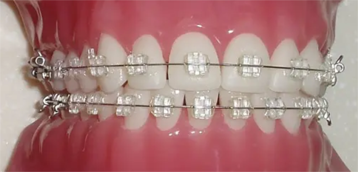牙齿|“戴牙套”前的准备工作有哪些？