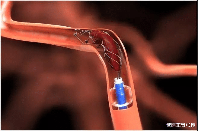 老年病|84岁老太太脑血管狭窄，还能放支架通血管吗？医生说了一句话