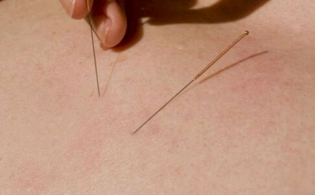 针灸|著名中医董景昌，人称“当代针圣”，独创“董氏针灸”，风靡世界