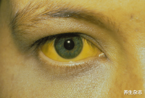 肝脏|吃维生素会伤肝？提醒：不想肝“烂如渔网”，2种维生素别瞎吃