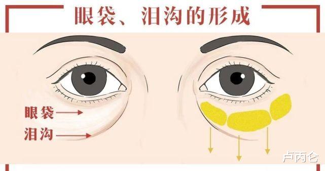 填充泪沟之后，为什么出现了一条棱？