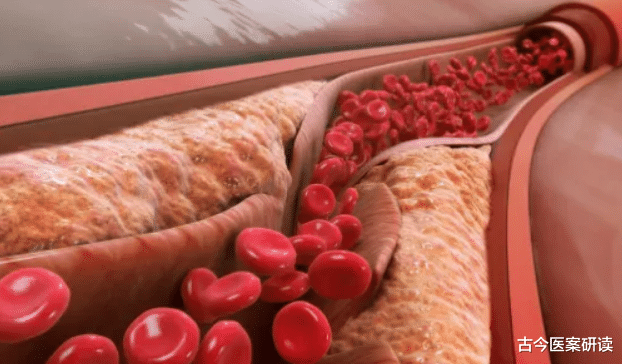 高血压|研究高血压50年,76岁心内科院士20年没并发症,他分享3条降压经验