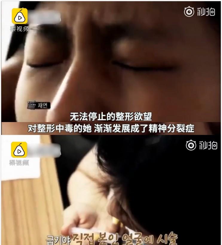 王一博|女星韩慧景:为了更漂亮,给脸注射食用油,把脸整成“猪头”