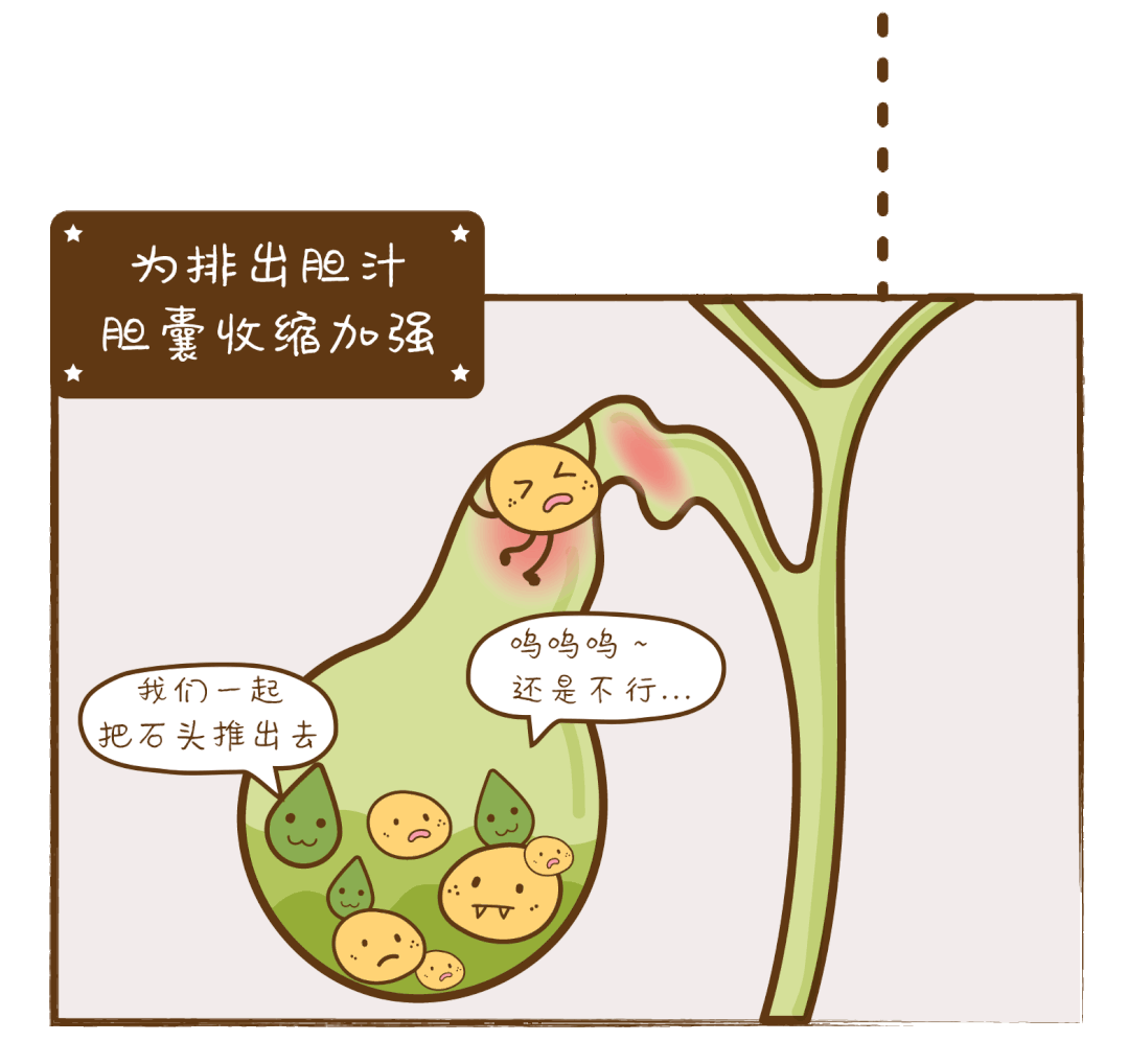 心脏病|胆结石是如何排出体外的?会划破胆管吗?