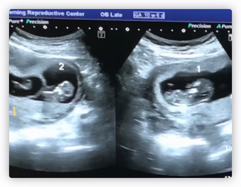 明金成|52岁男星晒喜讯,妻子剖腹产生下一儿一女,曾打算做丁克一族