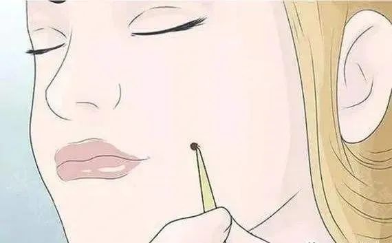 黑色素瘤|点痣要慎重 如何分辨痣是否癌变?