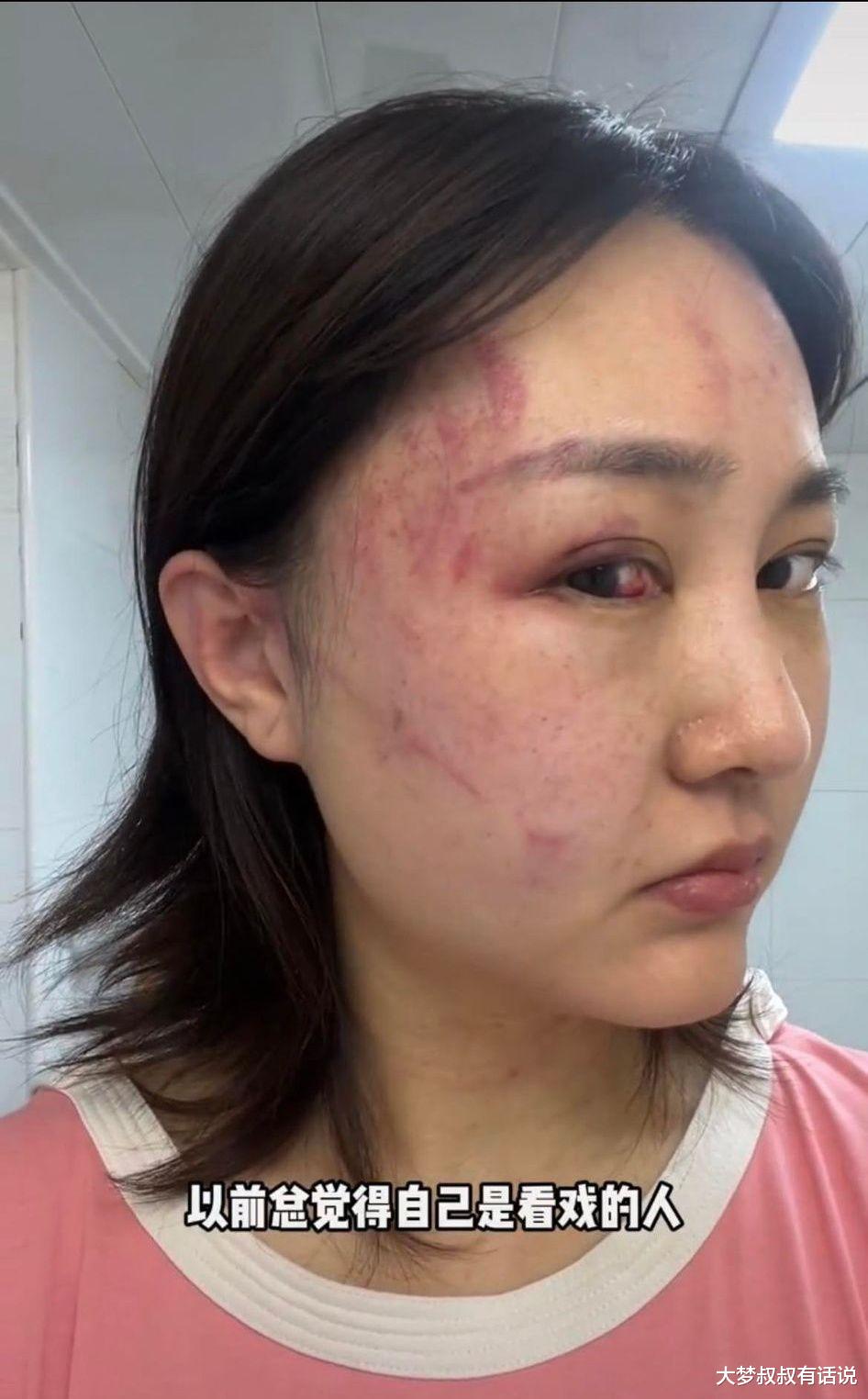徐大宝|百万网红“半年遭老公家暴4次”被打到面目全非,痛哭曝濒死过程!