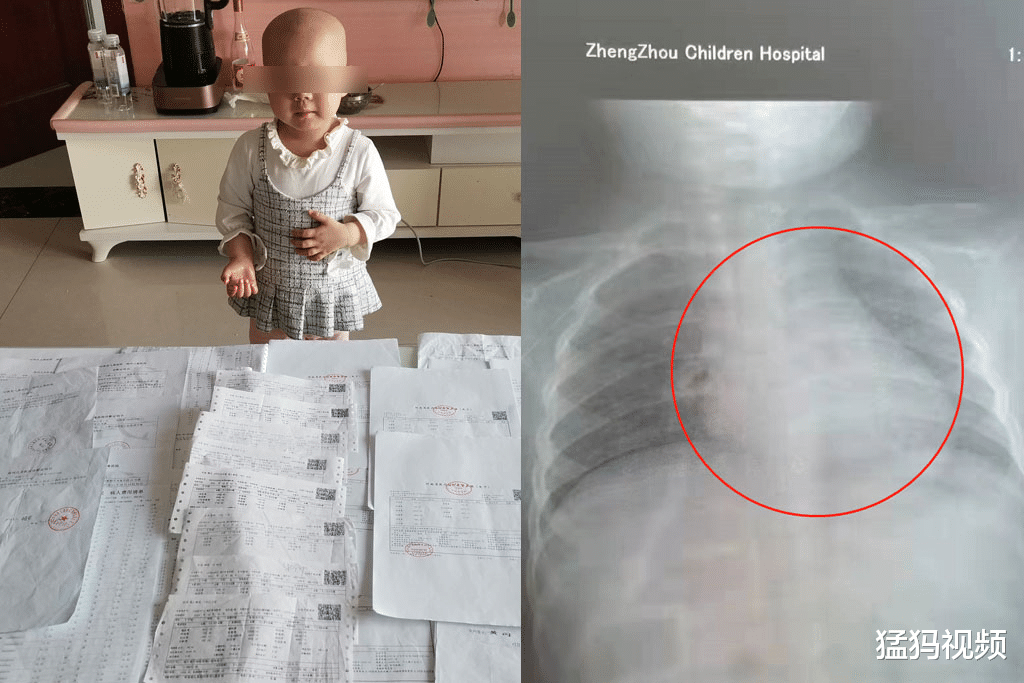 肿瘤|3岁女童胸腔肿瘤如成人拳头大小