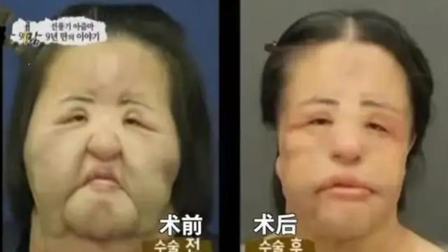 韩慧景|曾经的港风美人，头部被注射机油，脸肿像馒头，是阴谋还是偏执？