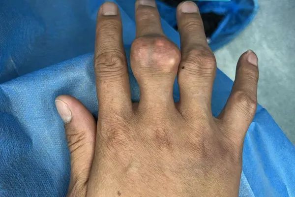 痛风|怎样溶解痛风石？吃药能溶解吗？