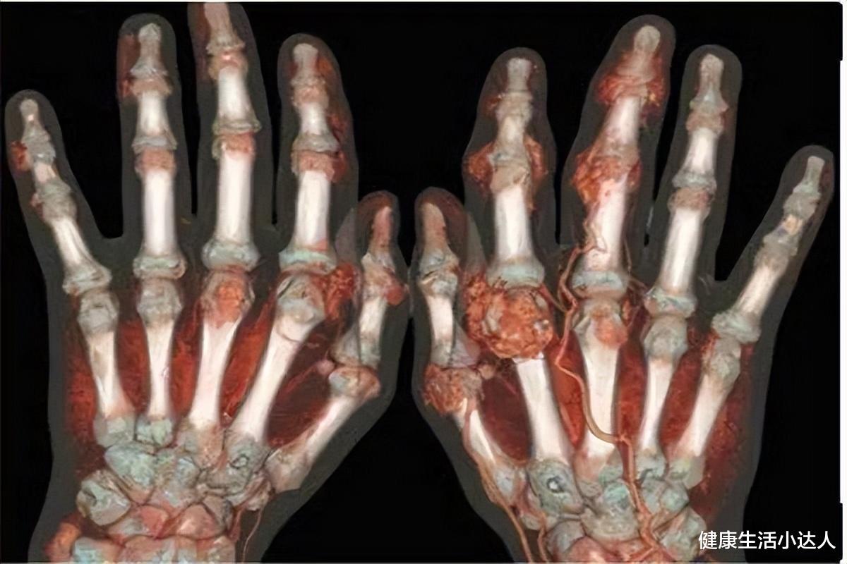 痛风|夏天容易诱发痛风,偏爱4种美食的人,尿酸难免要超标