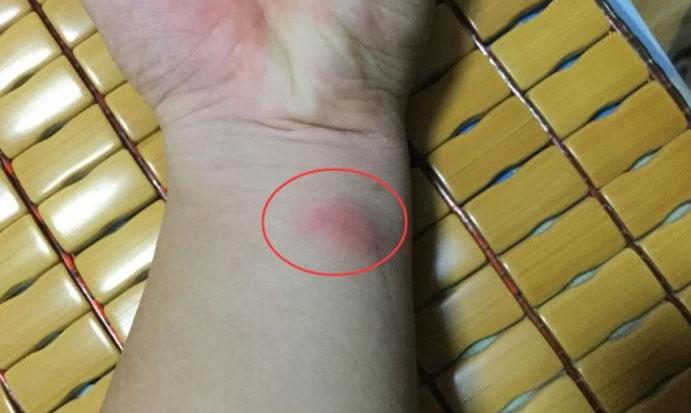 未皮试!22岁女子“高烧连打3针”身亡:家属索赔100万,拒绝尸检!