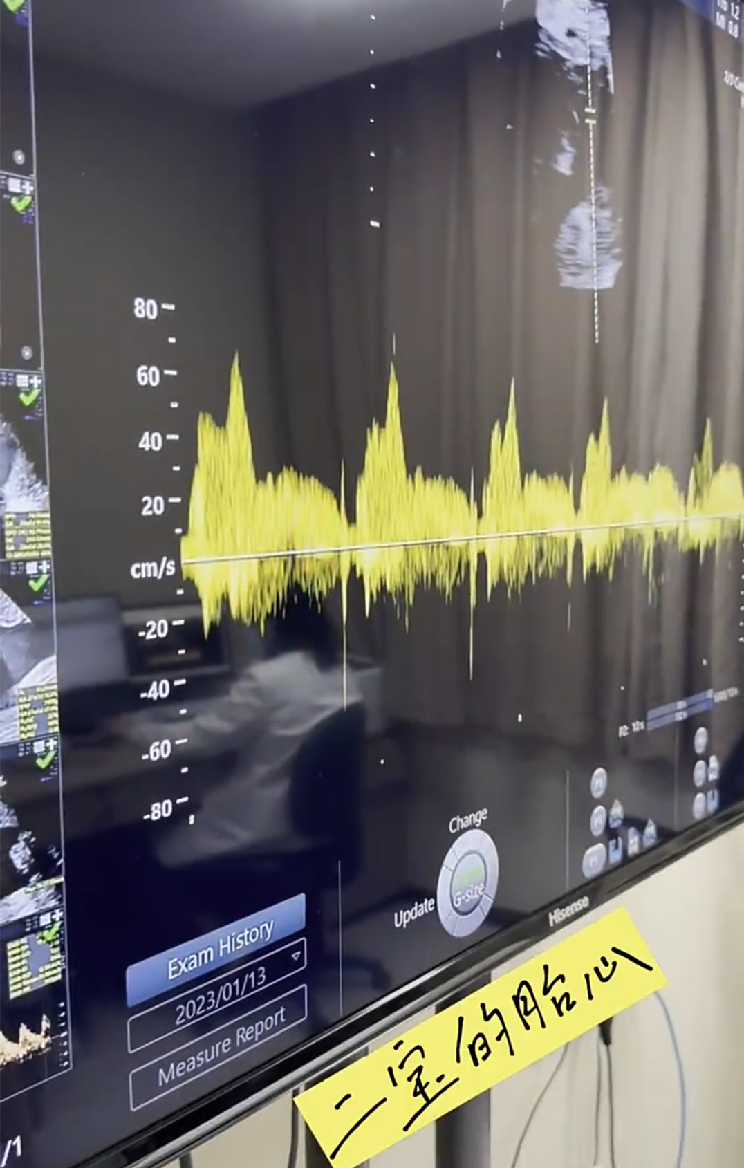 丁一|白冰前夫已再婚,带娇妻产检超恩爱,宝宝四维图曝光鼻子像爸爸