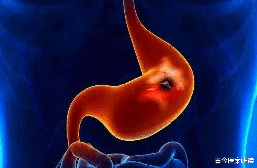 胃癌|“胃癌大户”被揪出,餐餐不少的“美味佳肴”,或致胃部癌变,别再贪嘴