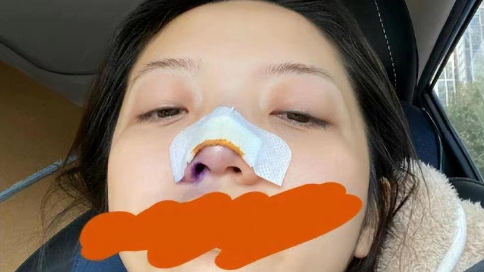 张兆艺|演员张兆艺晒受伤照片，自曝惨遭妈妈家暴，鼻子受伤裹纱眼眶含泪