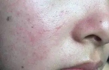 干性、油性、敏感肌肤不同肤质如何选择面霜，怎么吃比较好？